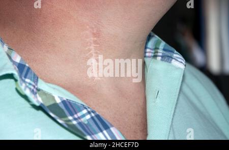 Cicatrice lasciata sul collo dopo un intervento chirurgico di un'erniazione del disco cervicale Foto Stock