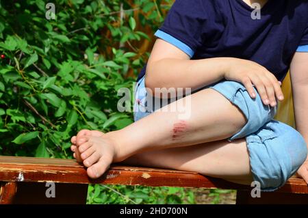 Closeup del ginocchio del bambino ferito dopo che è caduto giù sul pavimento, la gamba del ragazzo fa male. Livido, graffio dopo le passeggiate estive o gli sport. Unint anestetico Foto Stock