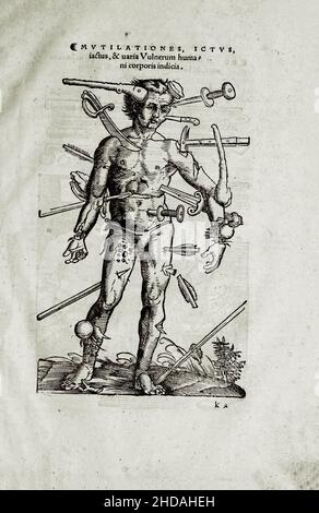 L'illustrazione di 16th secolo di chirurgia e interventi chirurgici nel Medioevo: Mutilazioni, rubinetto, lividi e diverse versioni delle ferite di Foto Stock