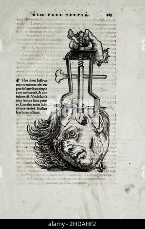 L'illustrazione di 16th secolo di chirurgia e interventi chirurgici nel Medioevo: Trepanation del cranio. Dai libri medievali di Octavius ho Foto Stock
