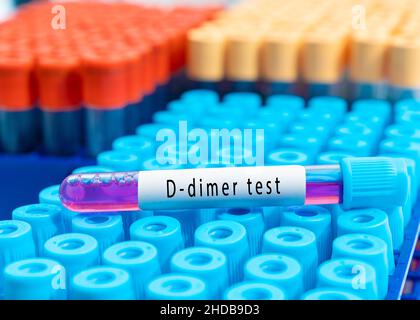 Provetta per analisi del sangue per test D-dimer, diagnosi di trombosi intravascolare dopo COVID-19 Foto Stock