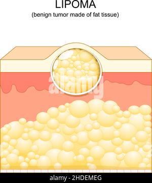 Lipoma tumori adiposi localizzati nei tessuti sottocutanei della pelle. Illustrazione vettoriale. Strati di pelle Illustrazione Vettoriale