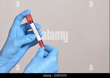 positivo, campione di sangue, corona virus, positivi, campioni di sangue Foto Stock