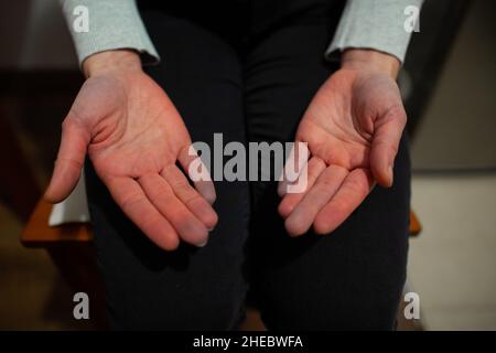 Mani di persona con fenomeno di Raynaud durante l'attacco con alcune dita diventano blu dopo il bianco, cambiamento di colore sindrome di Raynaud malattia di Raynaud Foto Stock