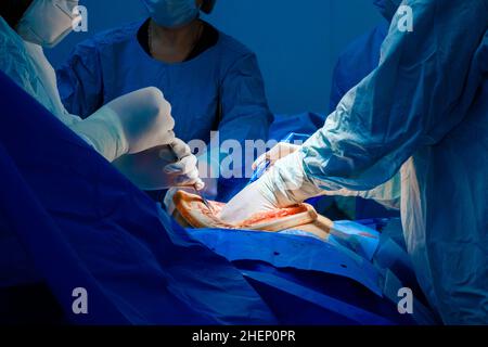 Un gruppo di chirurghi esegue un intervento chirurgico sulla cavità addominale del paziente. Messa a fuoco selettiva. Mani di medici in guanti bianchi sterili durante un intervento chirurgico. Foto Stock