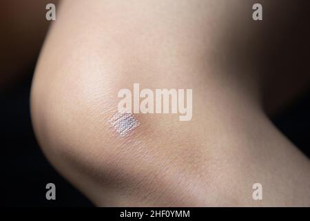 Segni dopo la rimozione dei capelli del laser o della cicatrice atopica dell'eczema dalla pelle. CO2 tecnica. Foto Stock