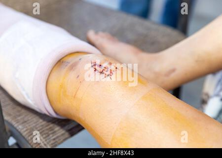 Nuova incisione e cicatrice dopo intervento chirurgico al ginocchio Foto Stock