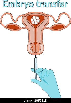 Fecondazione extracorporea in forma piatta e disegnata a mano. Diagramma di inseminazione artificiale. Trasferimento dell'uovo fecondato nell'utero. Embrione tra Illustrazione Vettoriale