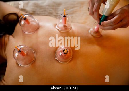 Una giovane donna si rilassa in una sala massaggi. Ventose di terapia medica di cupping sulla schiena della donna, primo piano, medicina tradizionale cinese. Foto Stock