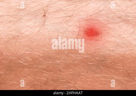 Ferita rossa sulla pelle di una gamba pelosa dell'uomo, primo piano. Foto Stock