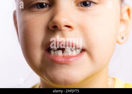 Primo piano del volto della ragazza giovane che mostra il dente del bambino anteriore mancante guardando la fotocamera su sfondo bianco. I primi denti che cambiano andando al dentista fare il dente Foto Stock