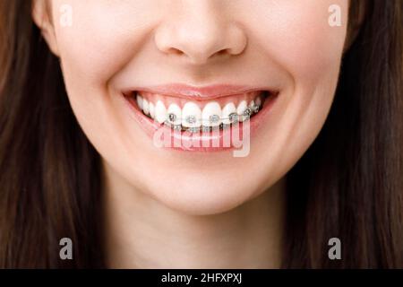 Trattamento ortodontico. Per le cure dentarie concetto. Bella Donna sorriso sano vicino. Primo piano in ceramica e le staffe di metallo sui denti. Bella Smil femmina Foto Stock