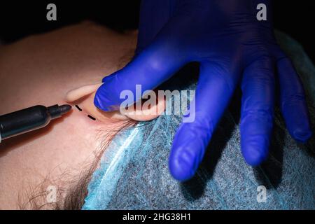 Un chirurgo di plastica esegue un'operazione per correggere le orecchie di una paziente femminile. Otoplastica, eliminazione delle orecchie sporgenti, chirurgia plastica Foto Stock
