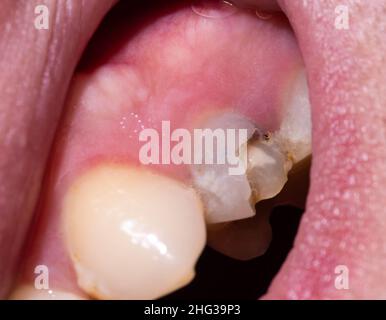 Pezzo scheggiato di un dente di polpa morto. Ripristino di un dente danneggiato in odontoiatria, difetto nello smalto dei denti, pareti sottili dei denti. Macro, trattamento Foto Stock