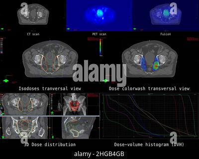 Panoramica della moderna pianificazione radiologica per la terapia del cancro della prostata con coinvolgimento dei linfonodi pelvici Foto Stock