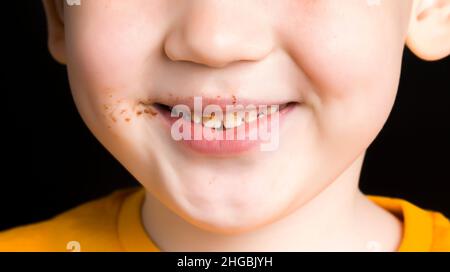 un ragazzo con carie sui denti, formato da un gran numero di dolci e scarsa cura dentale, ritratto da vicino di un bambino piccolo Foto Stock