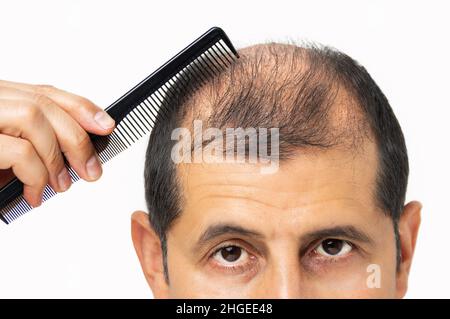 Alopecia umana o perdita di capelli - uomo adulto che tiene il pettine sulla testa del calvo Foto Stock