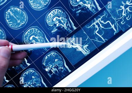 Medico che punta con la penna al vaso sanguigno cerebrale sull'immagine MRI. Foto Stock