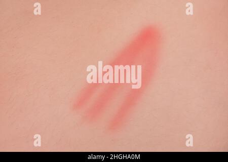 Lesioni da graffio rosso sulla pelle del corpo umano incidente, primo piano. Foto Stock