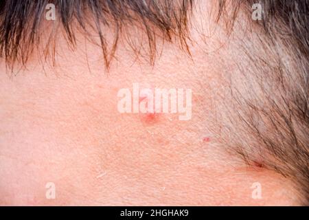 Pimples sulla fronte di un uomo. Acne sulla fronte Foto Stock