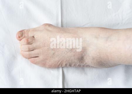 Bunion al piede della donna anziana con punta del martello e pelle asciutta su sfondo bianco. Igiene, chirurgia, assistenza sanitaria, podiatristo, dermatologia concetti Foto Stock