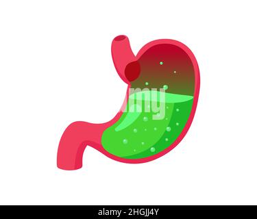 Gastrica GERD o avvelenamento con acido liquido verde all'interno. Malattia del ventre da reflusso gastroesofageo. Problema di bruciore di stomaco del sistema digestivo. Nausea e indigestione. Dolore addominale gastrico illustrazione medica Illustrazione Vettoriale
