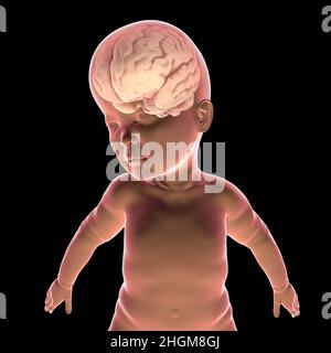Bambino con macrocefalia e cervello ingrandito, illustrazione Foto Stock