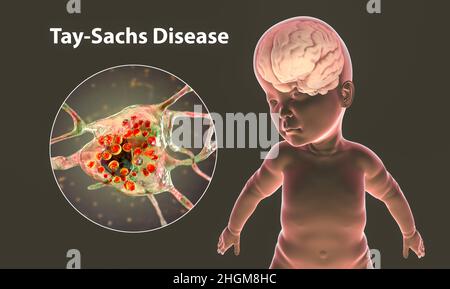 Malattia di Tay-Sachs, illustrazione del calcolatore Foto Stock