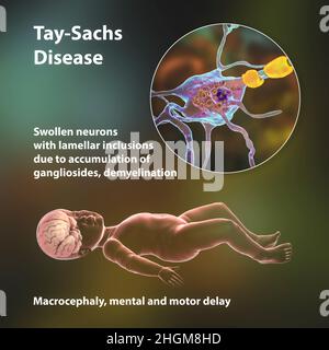 Malattia di Tay-Sachs, illustrazione del calcolatore Foto Stock