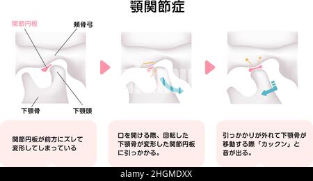 Illustrazione della causa dei disturbi temporomandibolari (TMD) Illustrazione Vettoriale