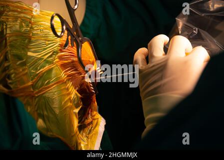 Vista ravvicinata della cannula inserita nel foro di perforazione per biopsia tumorale cerebrale nella sala operatoria neurochirurgica. Foto Stock