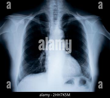 Immagine radiografica isolata su bianco Foto Stock