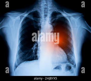Immagine radiografica del torace. Concetto di cancro polmonare Foto Stock