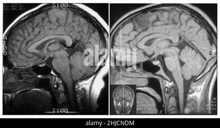 A sinistra è presente una scansione MRI (vista sagittale) del cervello normale di una femmina di 54 anni. A destra è una risonanza magnetica assiale del cervello di un maschio di 26 anni la cui testa è stata ferita in un incidente d'auto. La diagnosi della RM ha mostrato una piccola cisti aracnoidea nella regione frontale anteriore sinistra parasagittale (area grigia più scura in alto, verso la parte anteriore). Tutti gli altri aspetti erano normali. Foto Stock