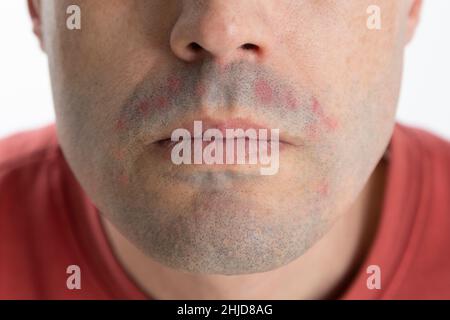 mento di un uomo con dermatite dopo la rasatura. Problemi di pelle maschile e irritazione Foto Stock