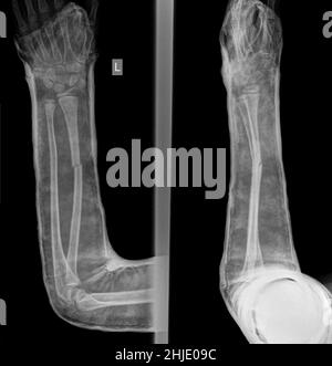 Mano fratturata in fusione, raggi X. Foto Stock