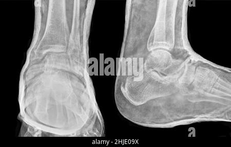 Caviglia fratturata in cast, raggi X. Foto Stock