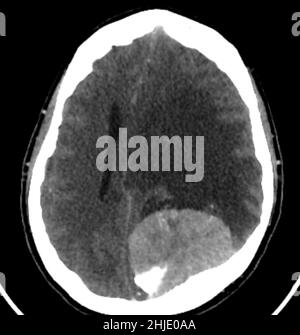 Meningioma, scansione TC Foto Stock