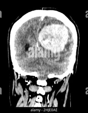 Meningioma, scansione TC Foto Stock