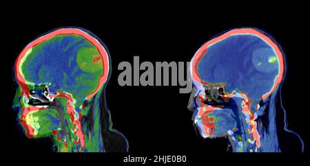 Meningioma, scansione TC Foto Stock