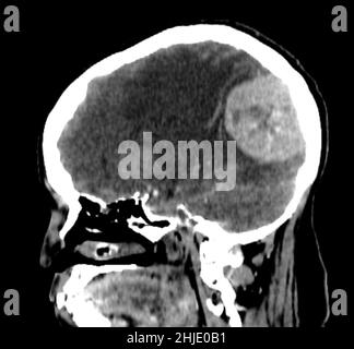 Meningioma, scansione TC Foto Stock