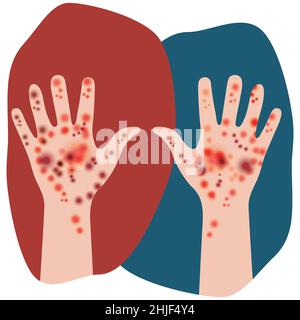 Due mani sollevate. Manifestazione di segni di malattia della pelle in persone con tono della pelle bianco. Rash su entrambe le mani. Irritazione, eruzione cutanea, dermatite. Desig Illustrazione Vettoriale