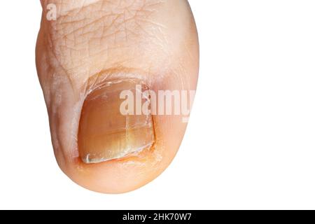 Particolare di un piede toenail con fungo. Primo piano della punta grande del piede con fungo su chiodo isolato su sfondo bianco Foto Stock