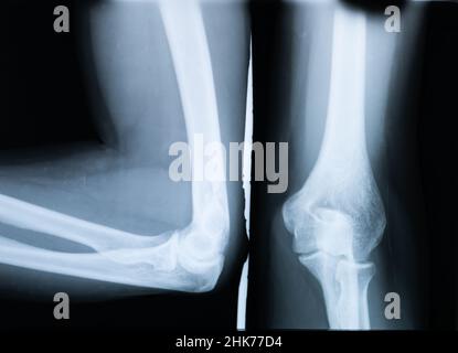 Raggi X con i polsi gomito di una donna con osteoartrite Foto Stock