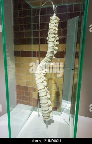 Modello della colonna vertebrale del re Riccardo III che mostra l'effetto della scoliosi, in mostra nel Centro visitatori del re Riccardo III, Leicester, Inghilterra. Foto Stock