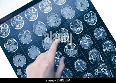 Dito rivolto verso l'area interessata nella testa del paziente sull'immagine MRI. Foto Stock