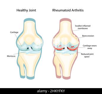 Artrite reumatoide RA che di solito colpisce le ginocchia. La malattia immunitaria automatica. Illustrazione vettoriale Illustrazione Vettoriale