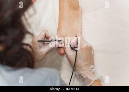 Il processo di rimozione permanente dei peli superflui sulle dita dei piedi utilizzando un dispositivo di elettroepilazione e pinzette. Foto Stock
