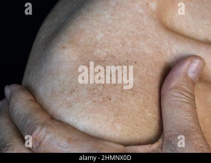 Macchie di età sul corpo dell'anziano asiatico. Sono macchie brune, grigie o nere e anche chiamate macchie di fegato, lentigine senile, lentigine solari, o macchie di sole Foto Stock