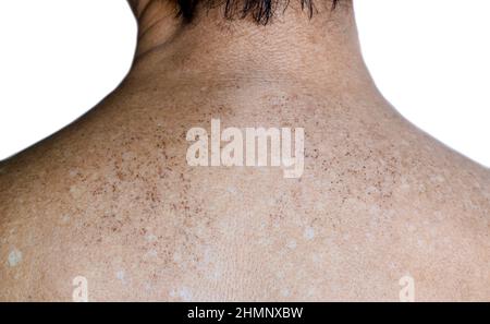Macchie di età e macchie bianche sulla parte superiore posteriore dell'anziano asiatico. Le macchie di età sono marrone, grigio, o macchie nere e anche chiamato macchie di fegato, lentigine senile, s Foto Stock